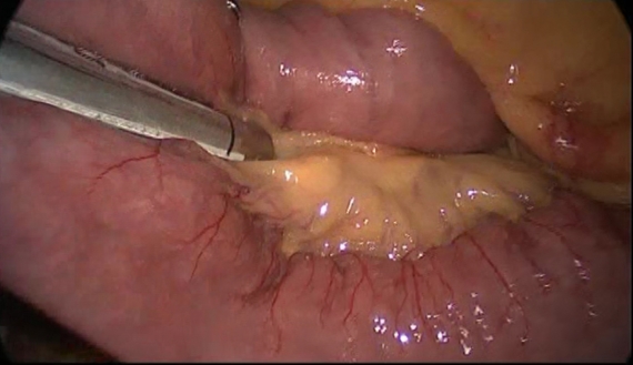 Small intestine divided during gastric bypass