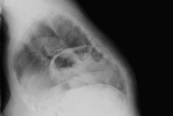 Type IV hiatal hernia with herniating colon