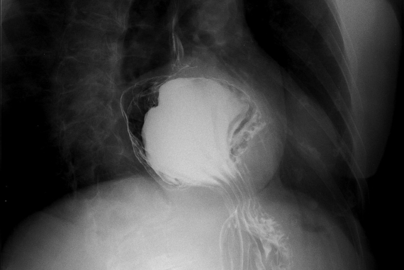 Stomach herniation during hiatal hernia