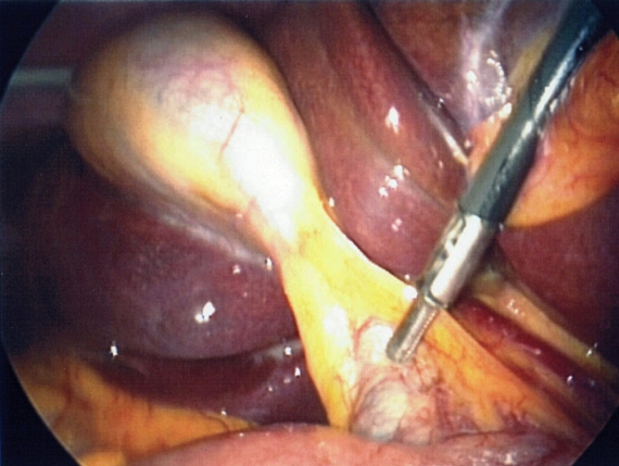 Critical view during laparoscopic cholecystectomy