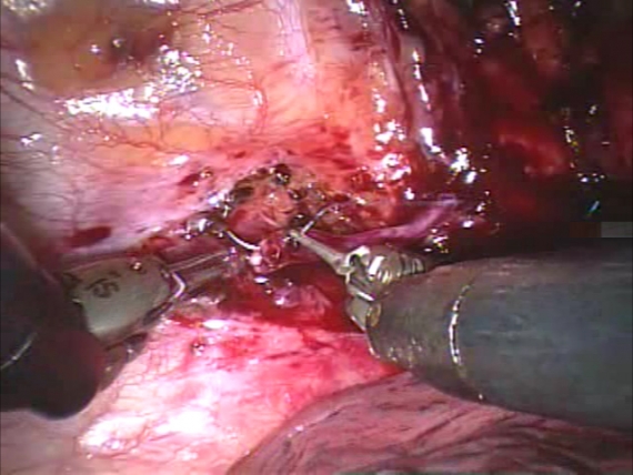 Nerve graft robotic anastomosis for severe compensatory hyperhidrosis