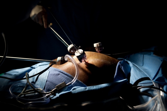 Laparoscopic ports during surgery