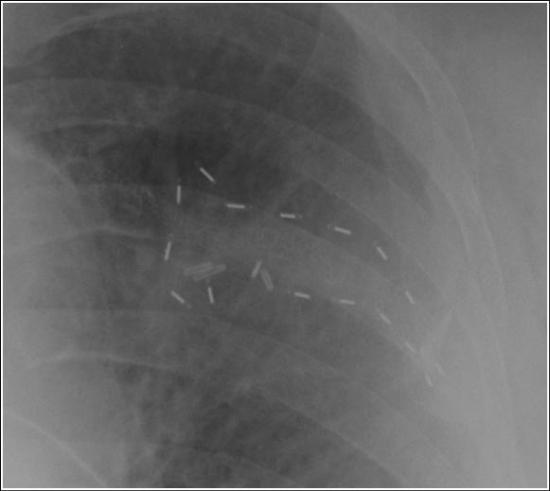 Xray demonstrating robotic brachytherapy seed placement