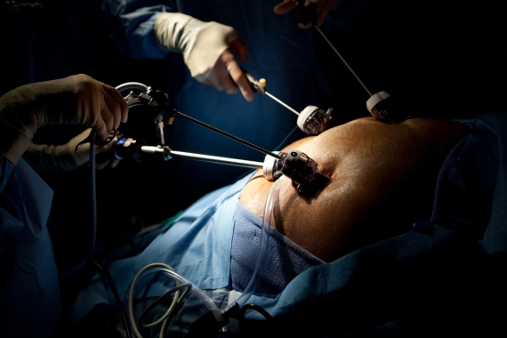 Laparoscopic weight-loss surgery