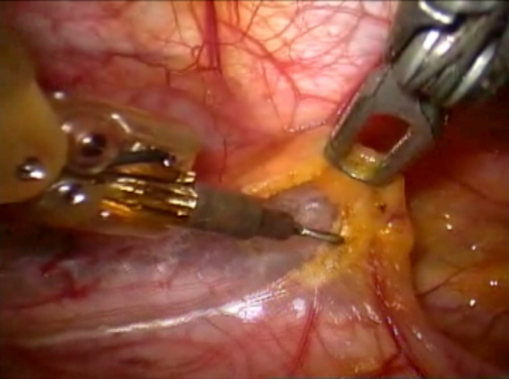 Robotic thymectomy