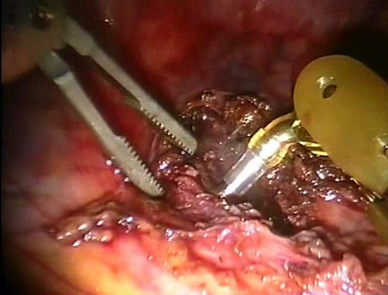 Robotic heller myotomy