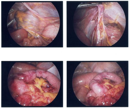 Laparoscopic reduction of internal hernia