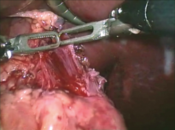 Gentle traction to perform robotic myotomy