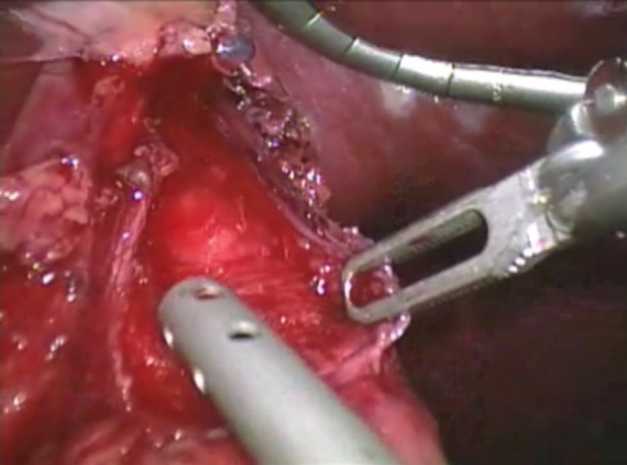 Esophageal mucosa visualized during robotic myotomy