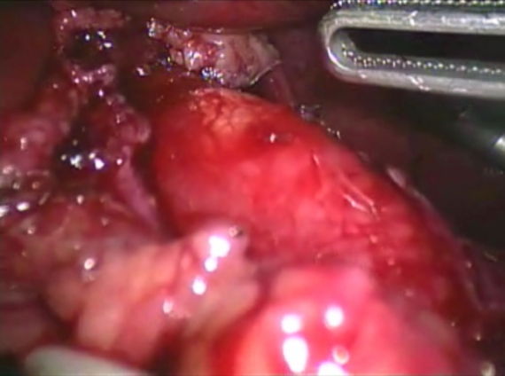 Transillumination of esophageal mucosa after myotomy