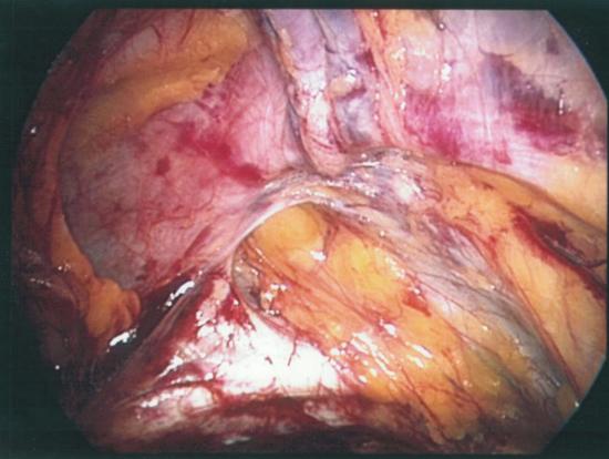 Laparoscopic inguinal hernia repair with direct type hernia