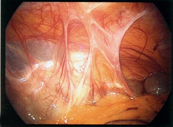 Peritoneal adhesions between large intestine