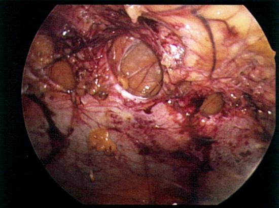 Fascial defects in abdominal wall causing hernias