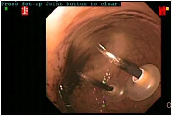 Intragastric Robotic Surgery Model