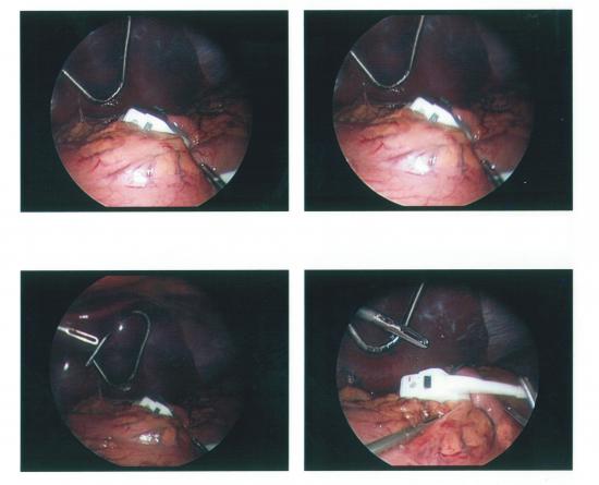 Lap-Band placement for morbid obesity