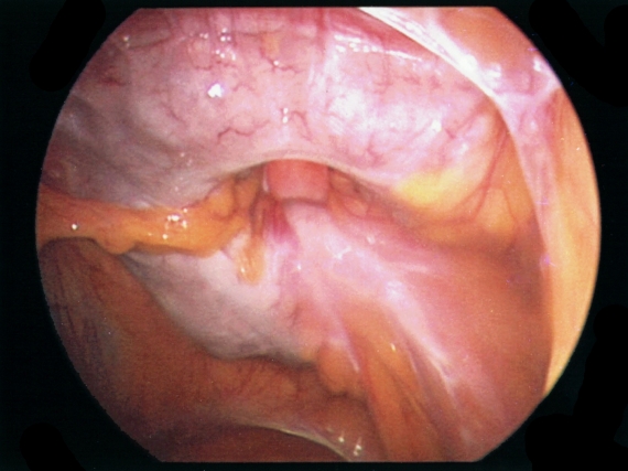 Abdominal intestines inside giant ventral hernia