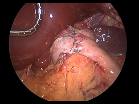 Nissen fundoplication