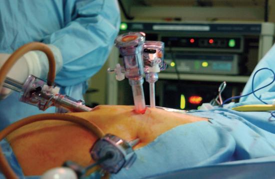 Evolving port technology for laparoscopic surgery