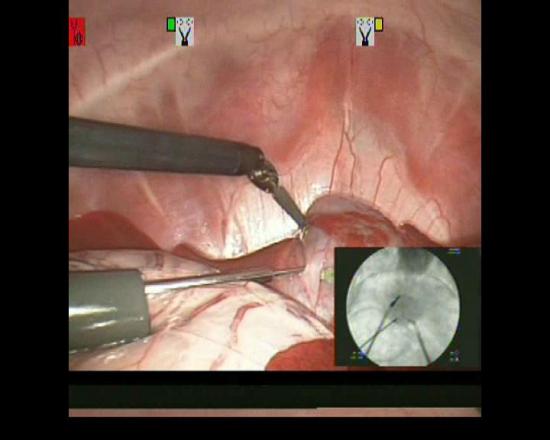 Picture in Picture instead of Overlay for Fluoroscopy