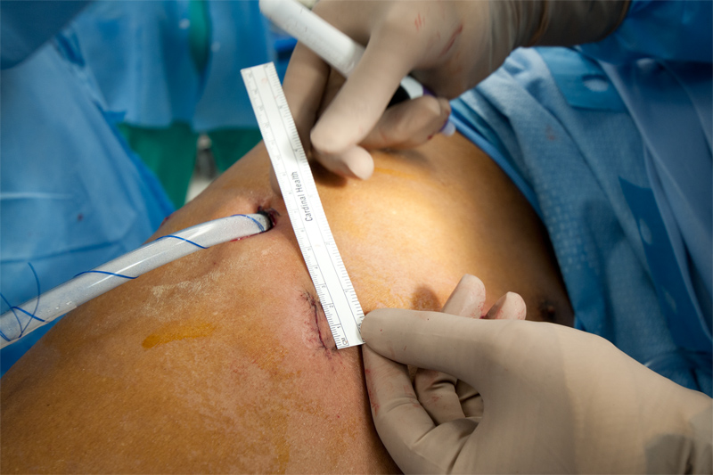 A ruler is used to demonstrate the small cuts of a robotic lobectomy