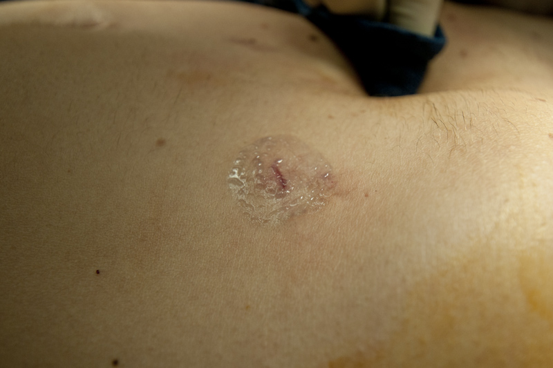 Healing and Recovery Laparoscopic.MD