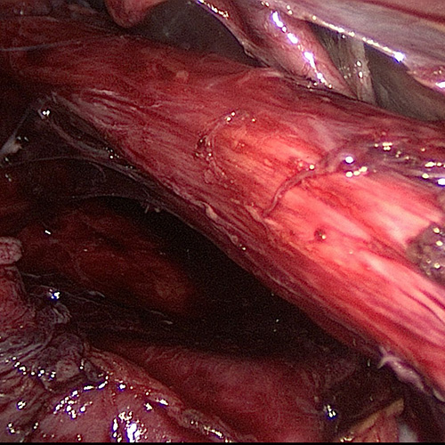 Esophagus transversing diaphragmatic hiatus