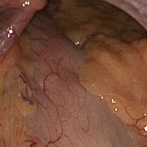 Diaphragmatic hernia showing opening in hiatus