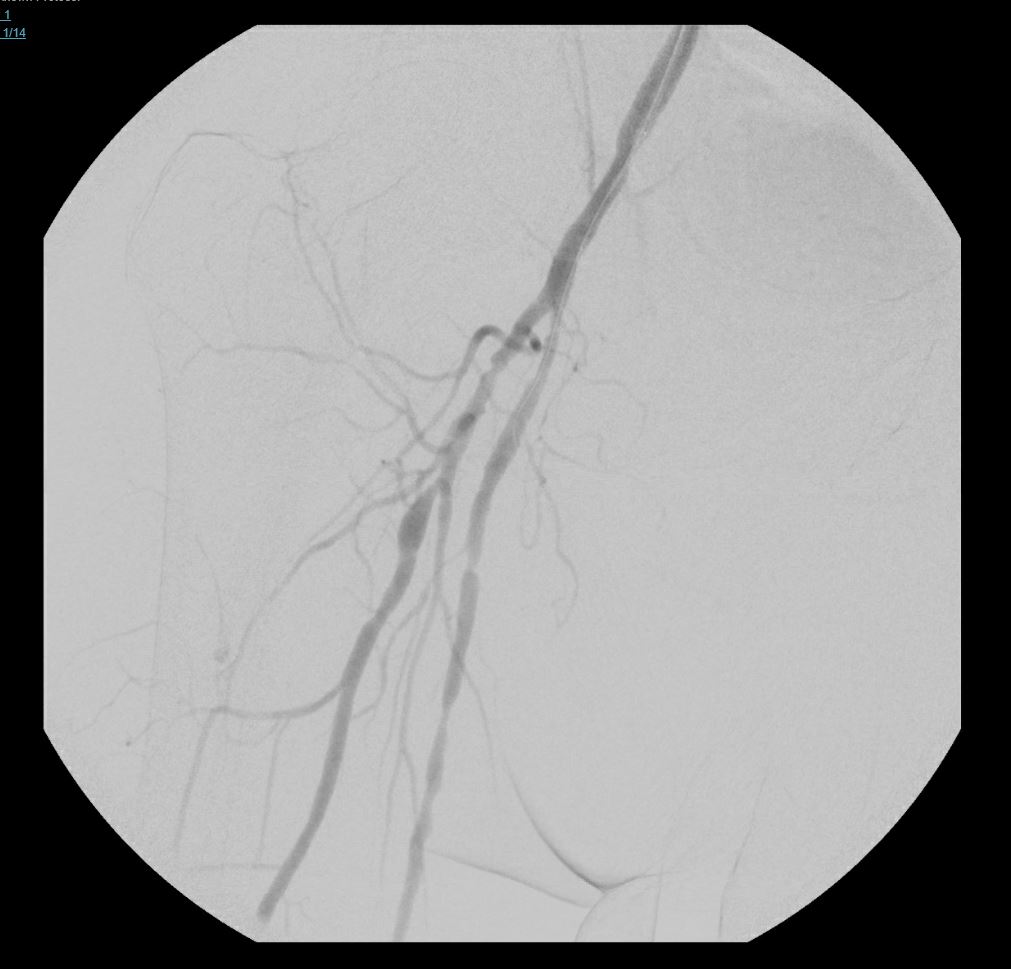 Arteriogram of lower extremity