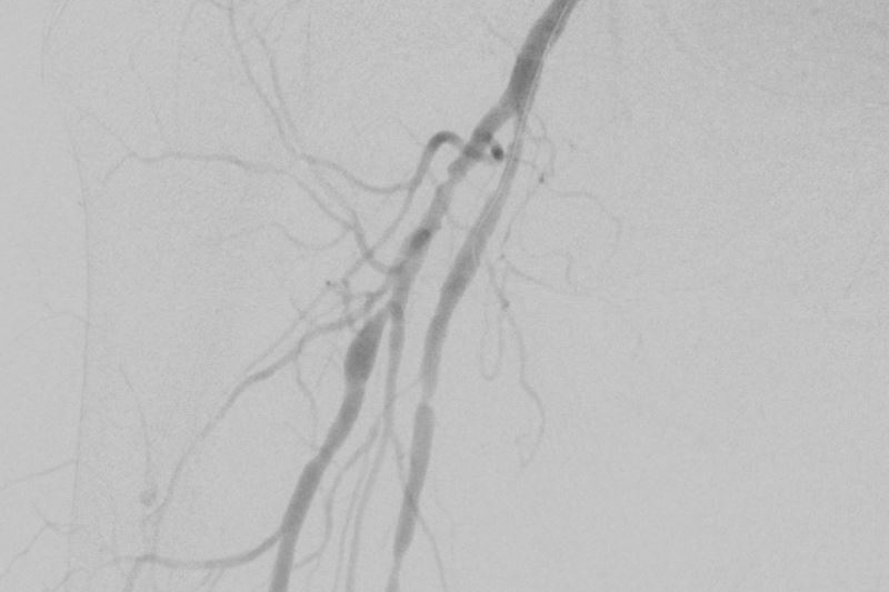 Arteriogram with cholesterol blockage