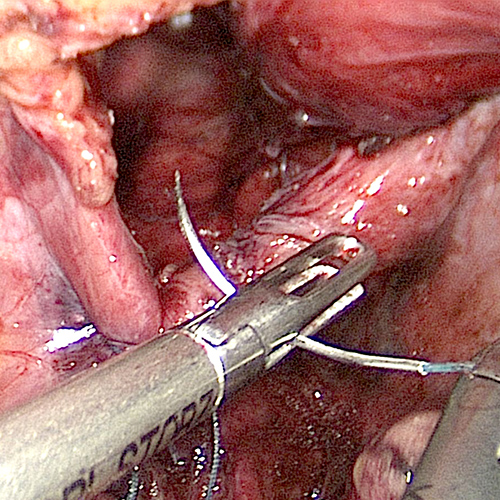 Defect in the diaphragmatic hiatus 