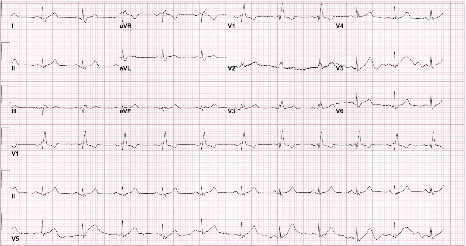 EKG with RBBB