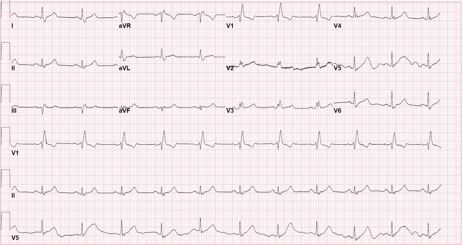 EKG with RBBB