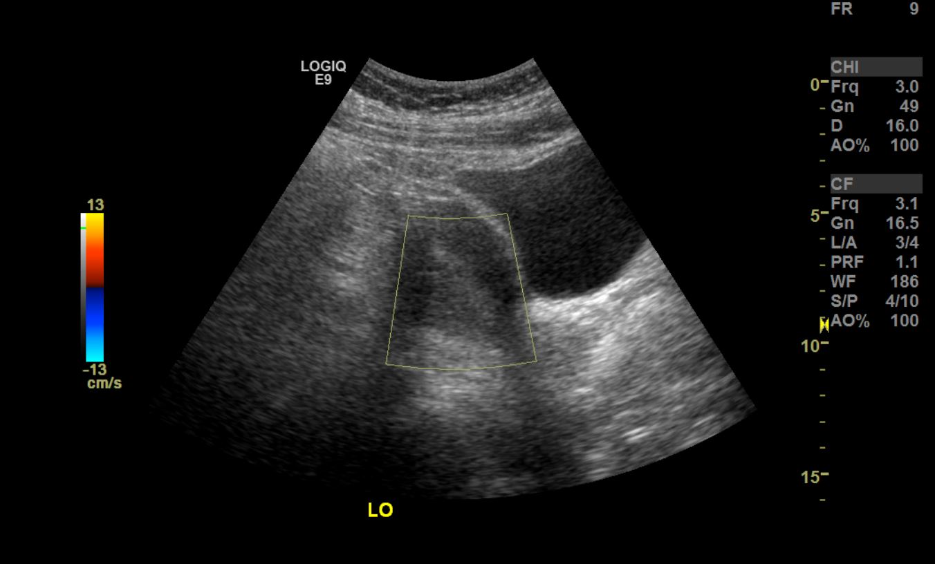 Ultrasound of endometrial stripe