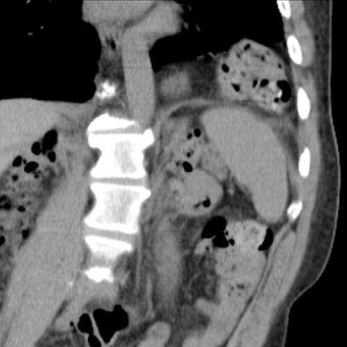 Hernia Through Diaphragm