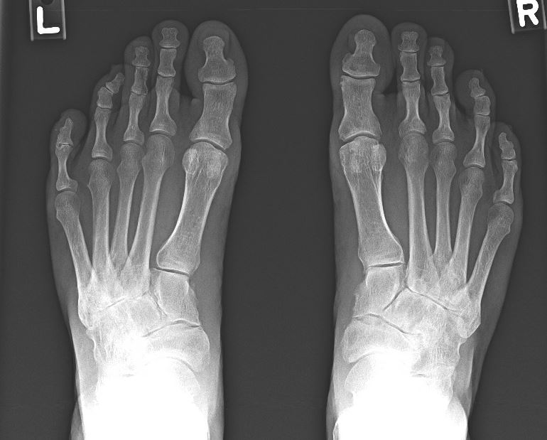X-rays of osteoarthritic feet