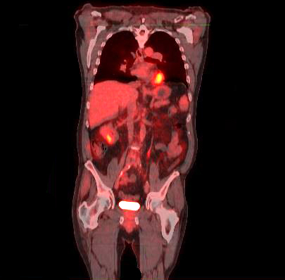 PET Scan demonstrating abdominal cancer