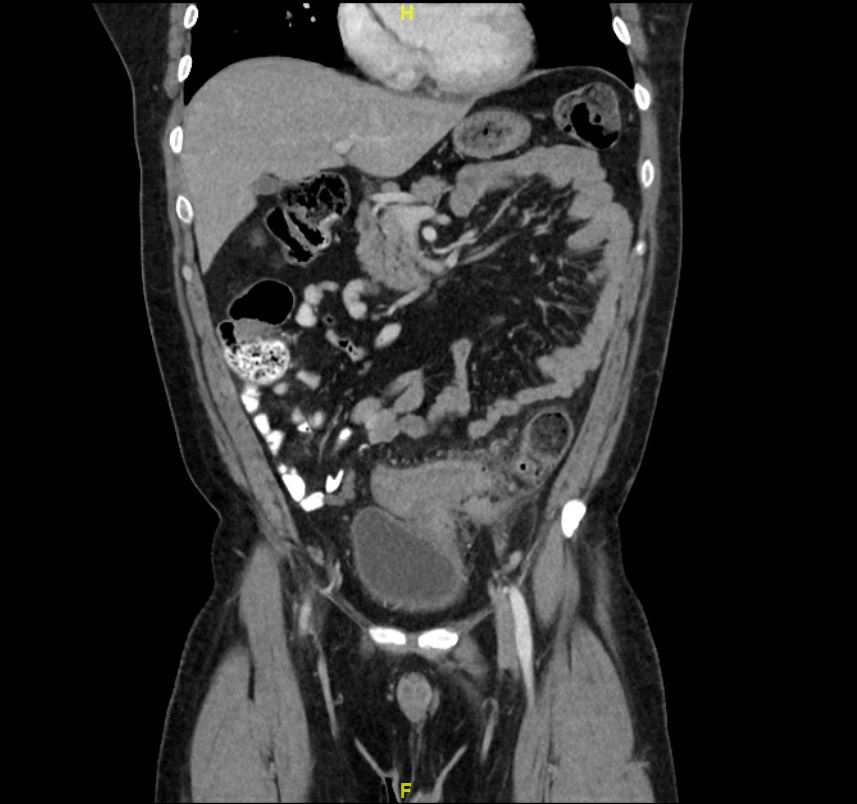 CT Scan Demonstrating Diverticulitis