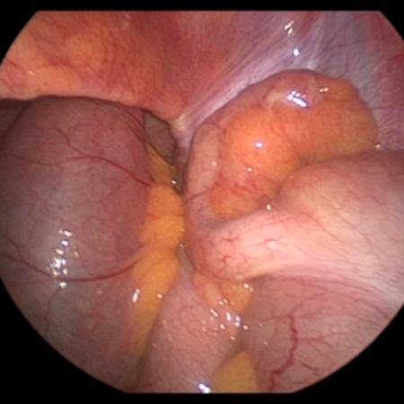 Inflamed appendix during laparoscopic appendectomy