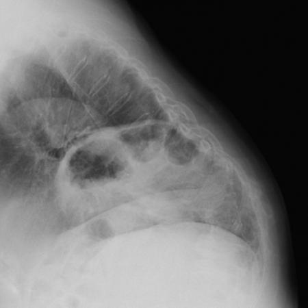 Type IV hiatal hernia with herniating colon