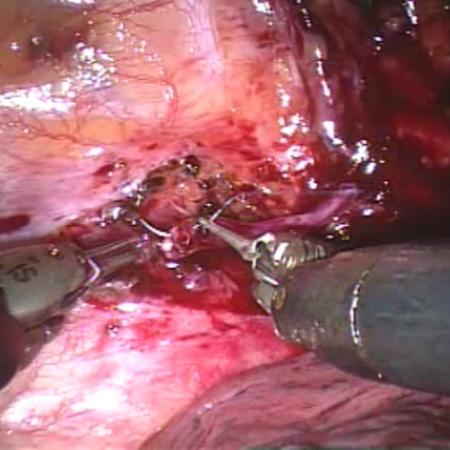 Nerve graft robotic anastomosis for severe compensatory hyperhidrosis