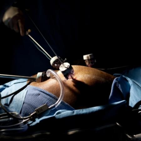 Laparoscopic ports during surgery