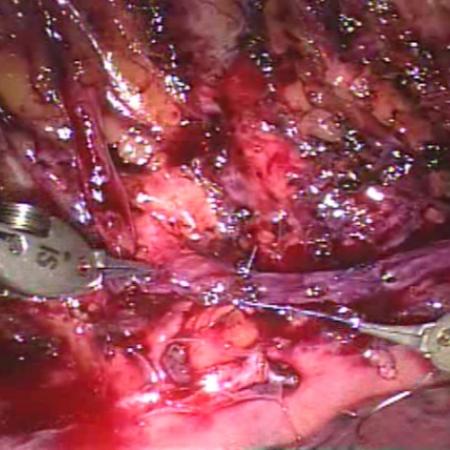 Suturing graft to ganglia during robotic sympathectomy reversal