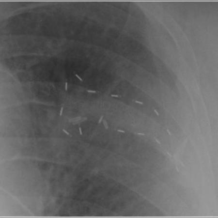 Xray demonstrating robotic brachytherapy seed placement