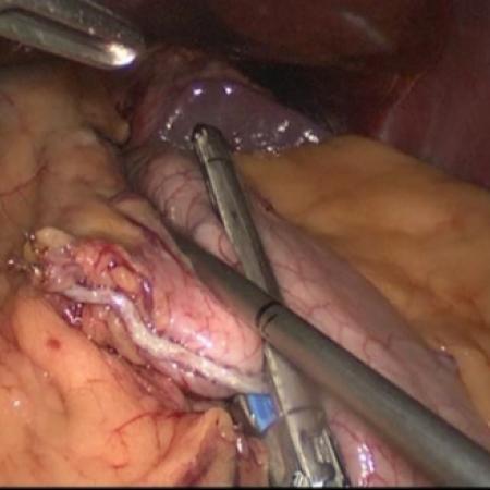 Stomach stapled into small pouch during gastric bypass