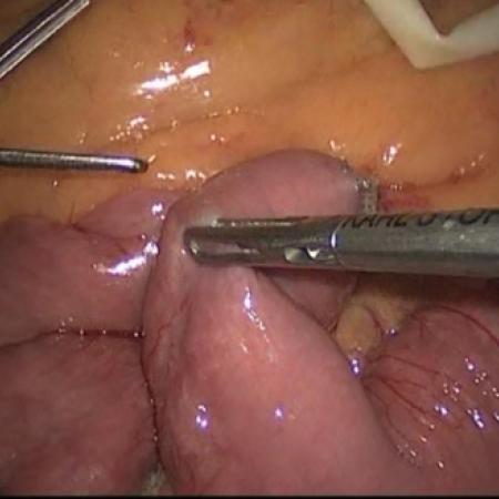 Preparing intestine for connection