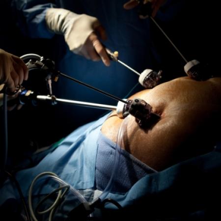 Laparoscopic weight-loss surgery