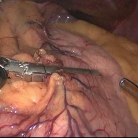 Initial stapling of stomach pouch across lesser curvature