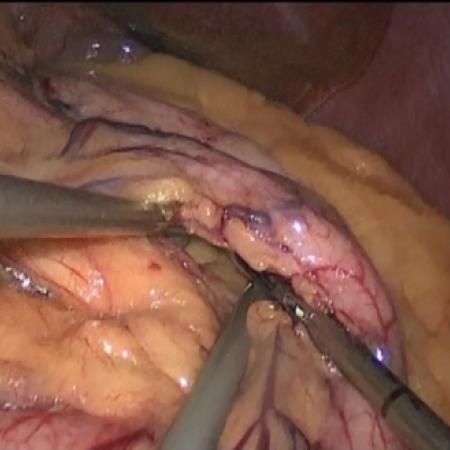 Dissecting Stomach Pouch during laparoscopic gastric bypass