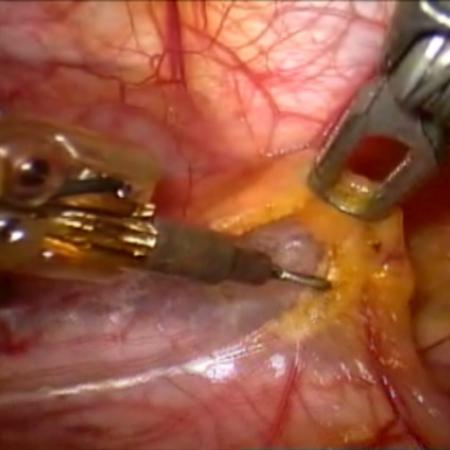 Robotic thymectomy