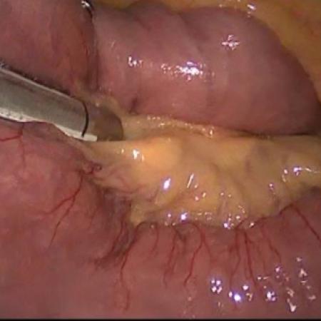 Small intestine divided during gastric bypass